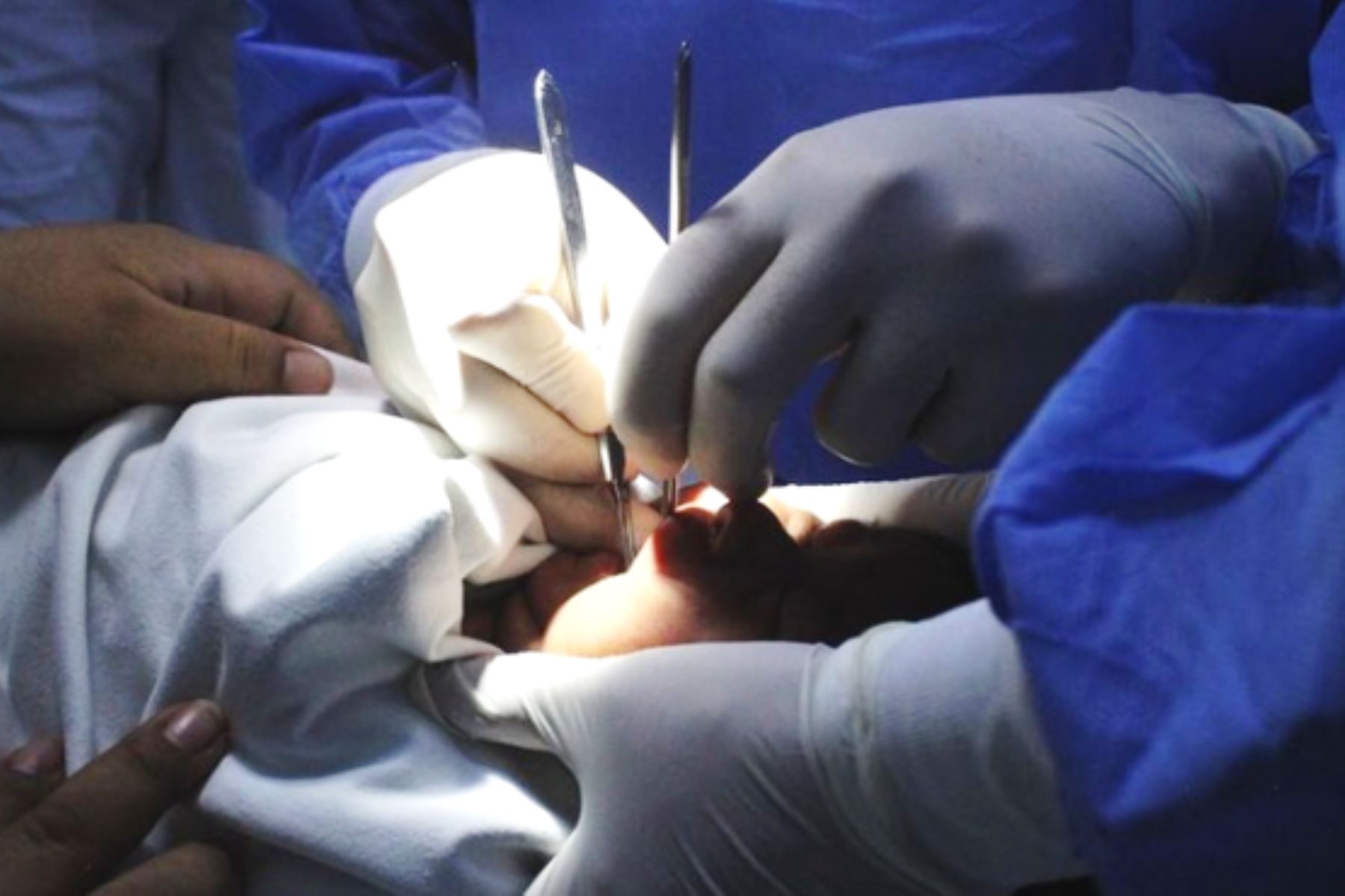 EsSalud realiza cirugías en lengua a recién nacidos para favorecer la lactancia materna. Foto: ANDINA/Difusión.