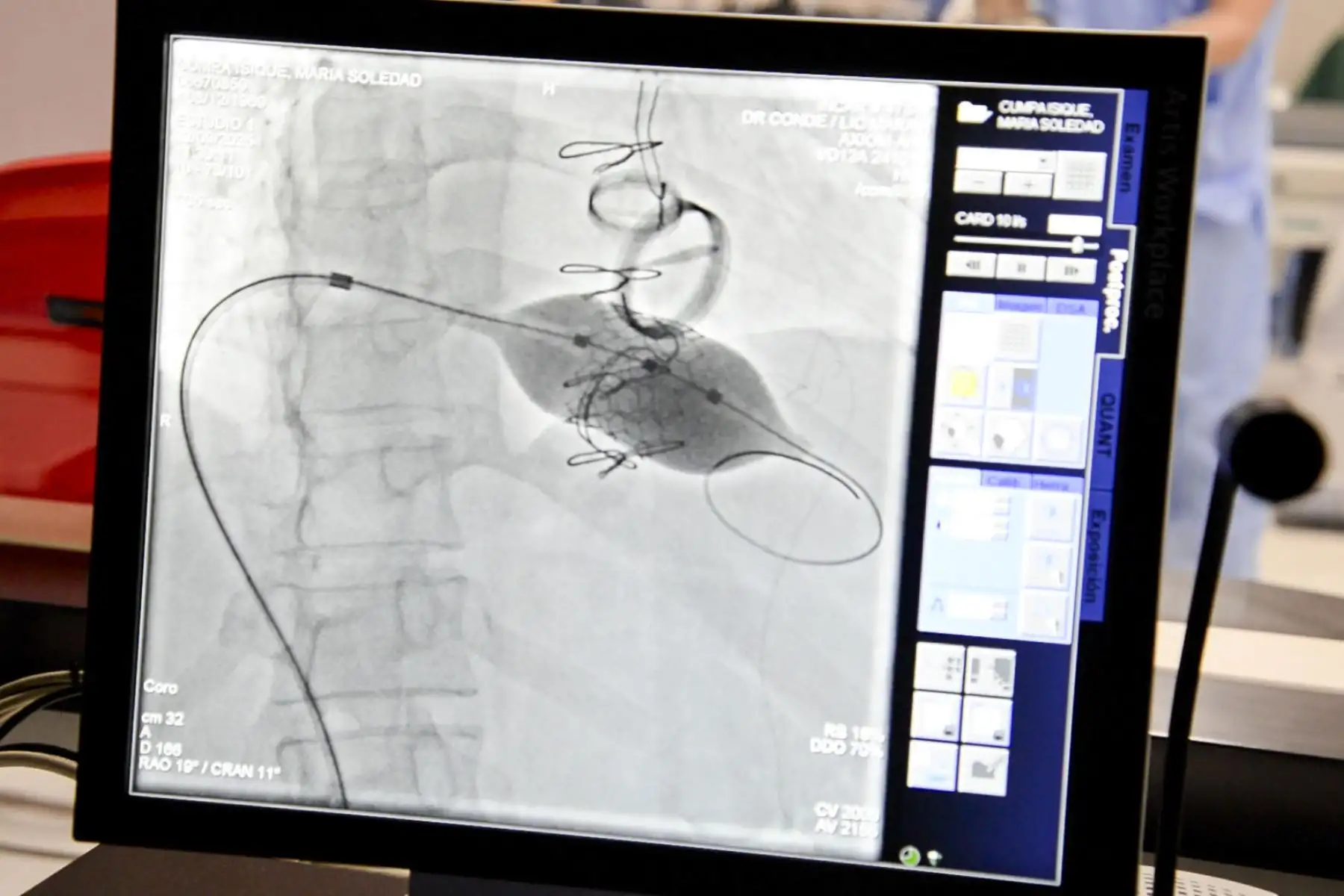 Durante muchos años, María Cumpa convivió con la fragilidad de un corazón que había sido operado tres veces. Le reemplazaron las válvulas aórticas, mitral y tricuspídea. Cada operación fue una batalla ganada, pero también una nueva marca en su cuerpo y en su ánimo. Con el paso del tiempo, una de esas válvulas volvió a fallar. Su salud se deterioraba y una cuarta cirugía a sus 55 años era un riesgo demasiado alto.
Foto: Incor Durante muchos años, María Cumpa convivió con la fragilidad de un corazón que había sido operado tres veces. Le reemplazaron las válvulas aórticas, mitral y tricuspídea. Cada operación fue una batalla ganada, pero también una nueva marca en su cuerpo y en su ánimo. Con el paso del tiempo, una de esas válvulas volvió a fallar. Su salud se deterioraba y una cuarta cirugía a sus 55 años era un riesgo demasiado alto.
Foto: Incor