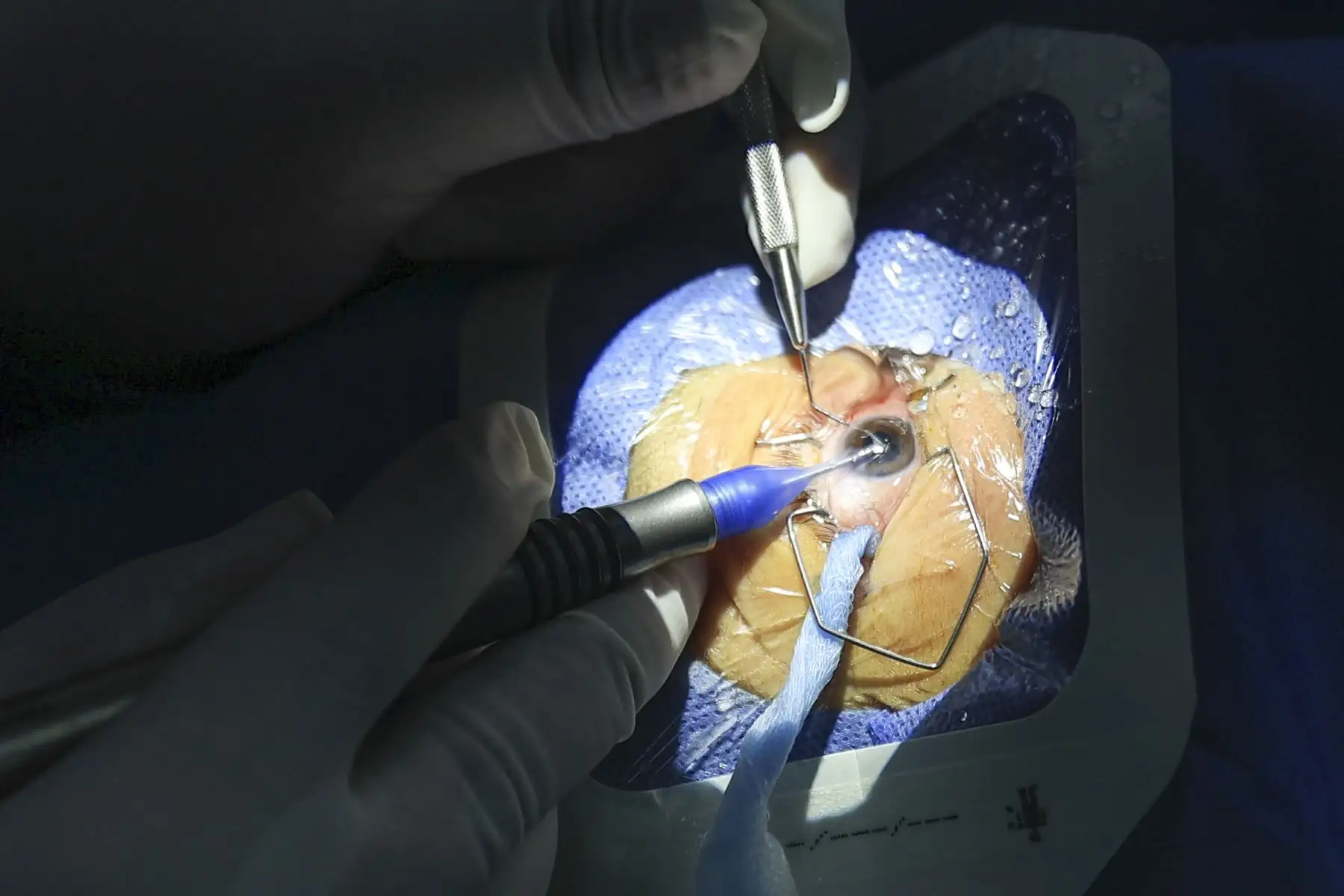 El Ministerio de Salud inició la campaña de salud ocular “Cataratón de la esperanza”, una jornada destinada a garantizar el acceso oportuno a cirugías de catarata para pacientes derivados de hospitales de Lima. Durante diciembre, especialistas del Instituto Nacional de Oftalmología (INO) realizarán alrededor de 500 intervenciones, con el objetivo de mejorar la calidad de vida de las personas afectadas y reducir la lista de espera quirúrgica. Foto: ANDINA/Jhonel Rodríguez Robles