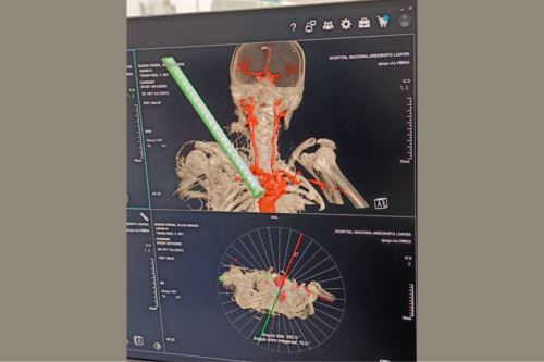 Silvia Bazán sufrió un accidente en su natal Huari, en la región Áncash, el 24 de diciembre, e inicialmente recibió atención en el hospital Víctor Ramos García de Huaraz. Foto: Minsa