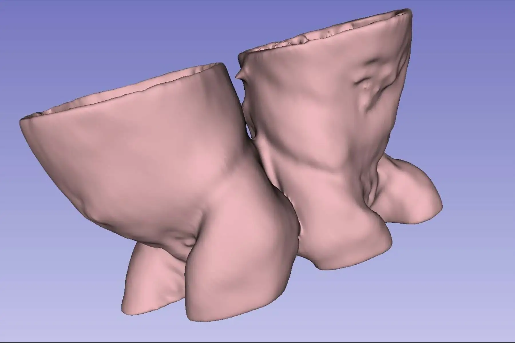 Durante la cirugía, los profesionales siguieron el plan previamente ensayado mediante realidad virtual, lo que permitió una ejecución precisa y coordinada en una operación de alta complejidad. Foto: ANDINA/Composición con fotos de Difusión