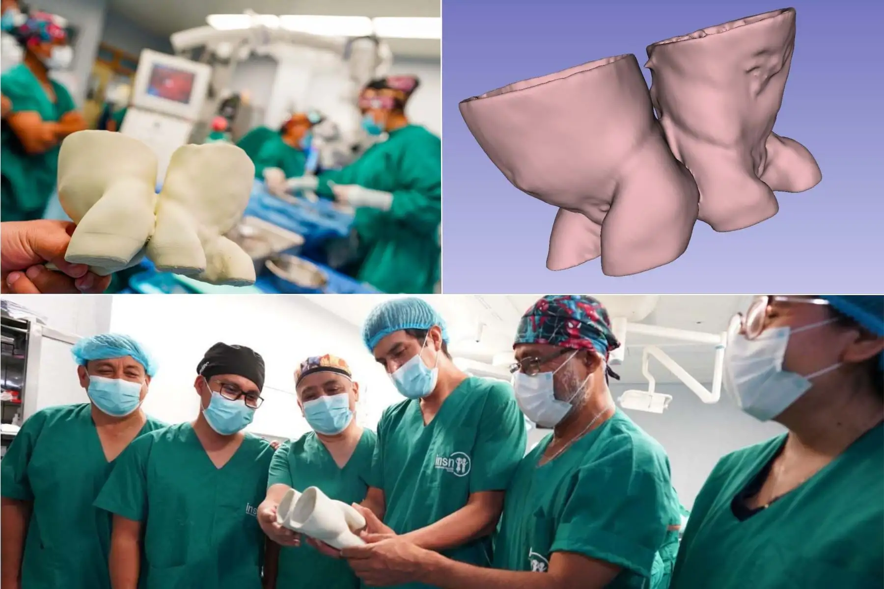 Un equipo multidisciplinario del Instituto Nacional de Salud del Niño San Borja empleó modelos 3D y realidad virtual para planificar la compleja separación de las gemelas siamesas Ailani y Alif Palacios Picón, unidas por la columna vertebral. La tecnología permitió una visualización precisa de su anatomía antes de la cirugía realizada el 18 de diciembre, que culminó con resultados favorables en la evolución de ambas pacientes. Foto: ANDINA/Composición con fotos de Difusión