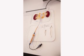 Sistema de denervación renal Symplicity Spyral de Medtronic, una tecnología basada en catéter diseñada para interrumpir las señales nerviosas que influyen en la presión arterial.
