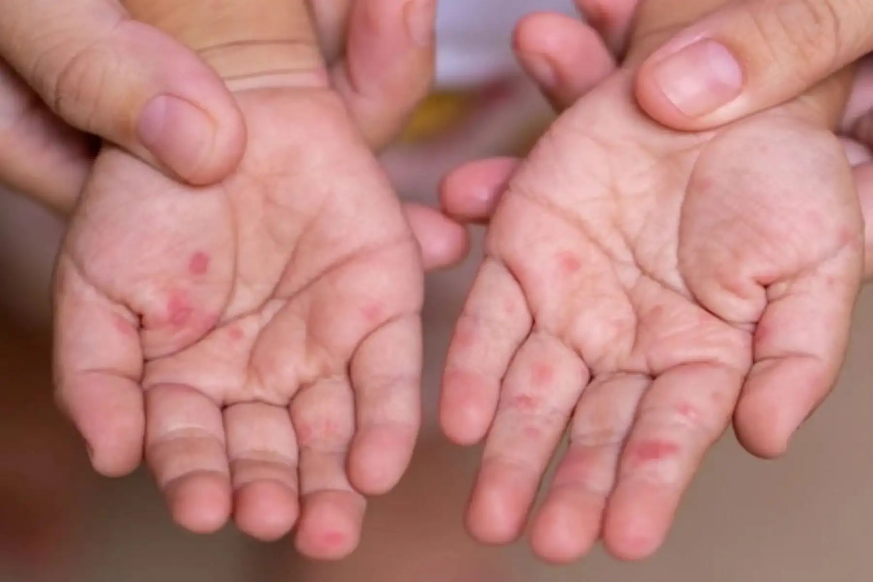 Chiclayo: UGEL dispone medidas preventivas en colegios por virus 