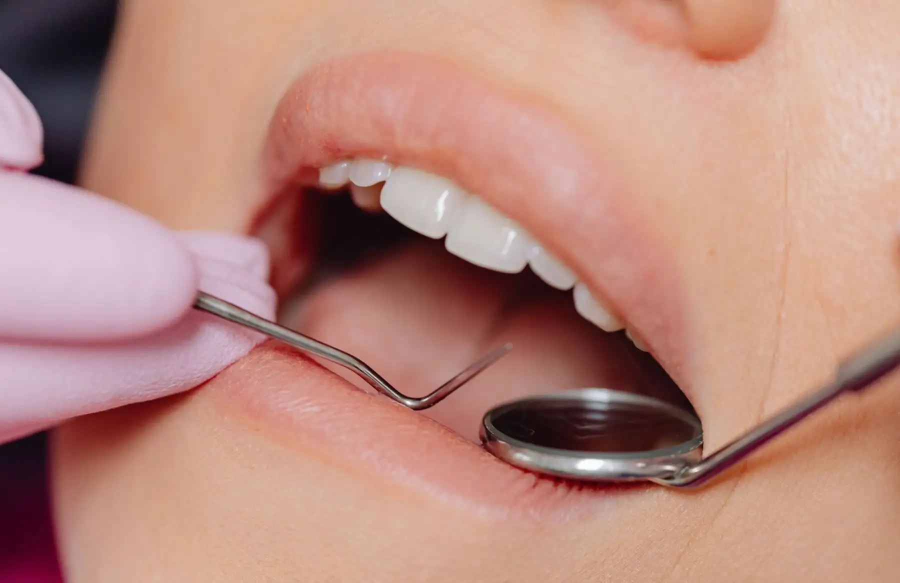 Carcinoma es el tipo de cáncer oral más frecuente en el Perú, según estudio