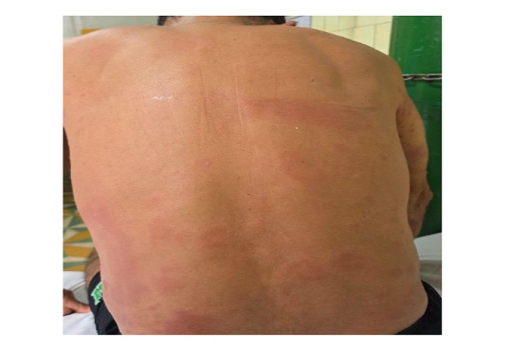 Sarampión en Loreto: reportan primer fallecido  y casos confirmados superan los 40