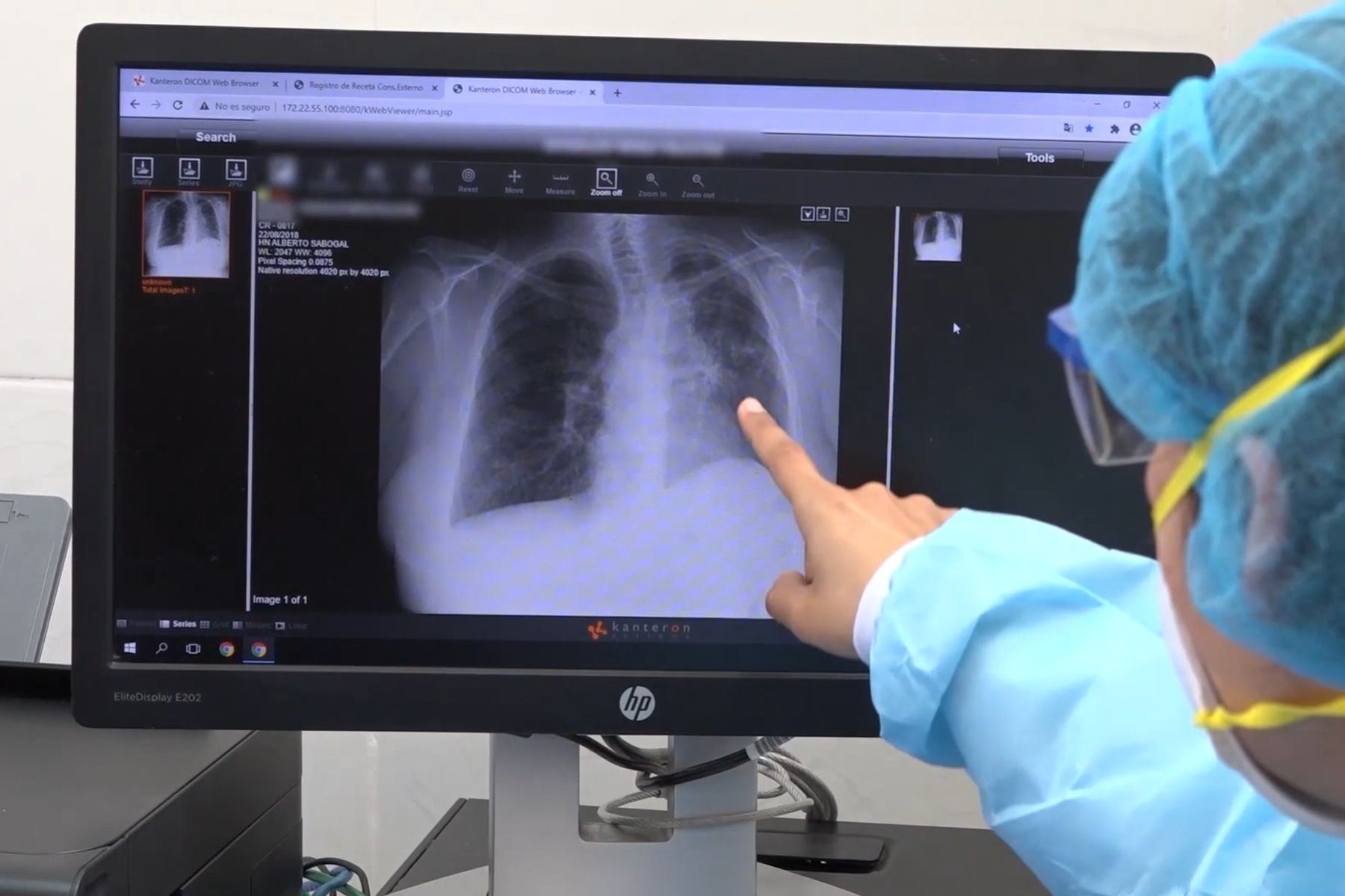 Nódulo pulmonar: ¿qué es, cómo se detecta y en qué casos se requiere cirugía?