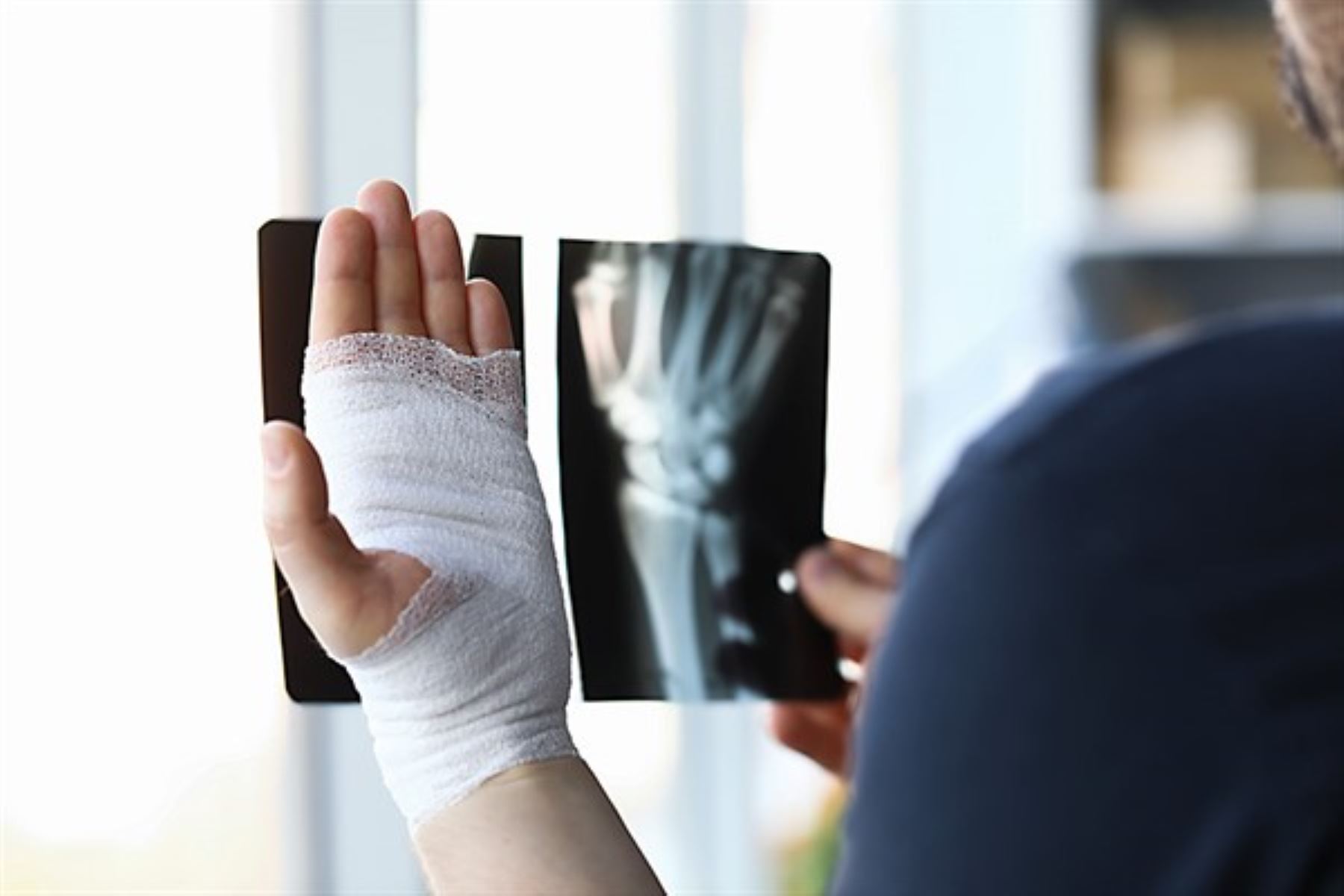 ¿Te fracturaste con una caída leve? Podría ser una señal de osteoporosis